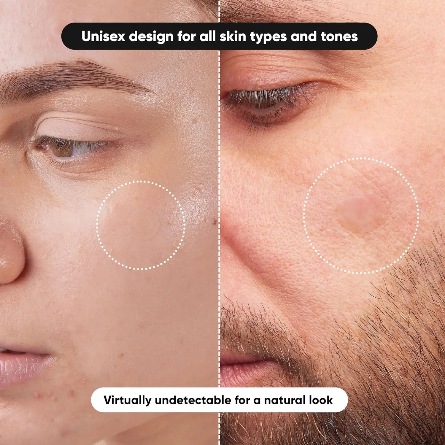 Pimple Patches | ORŸA